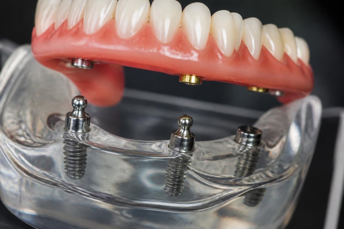 Implant-supported denture mechanics