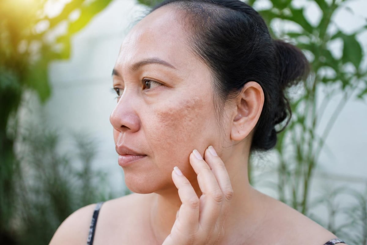 Melanin formation and dark spot development