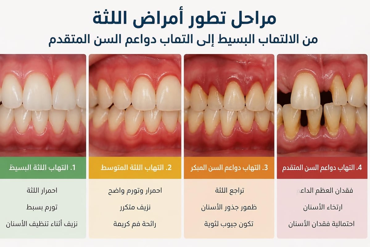 علامات أمراض اللثة