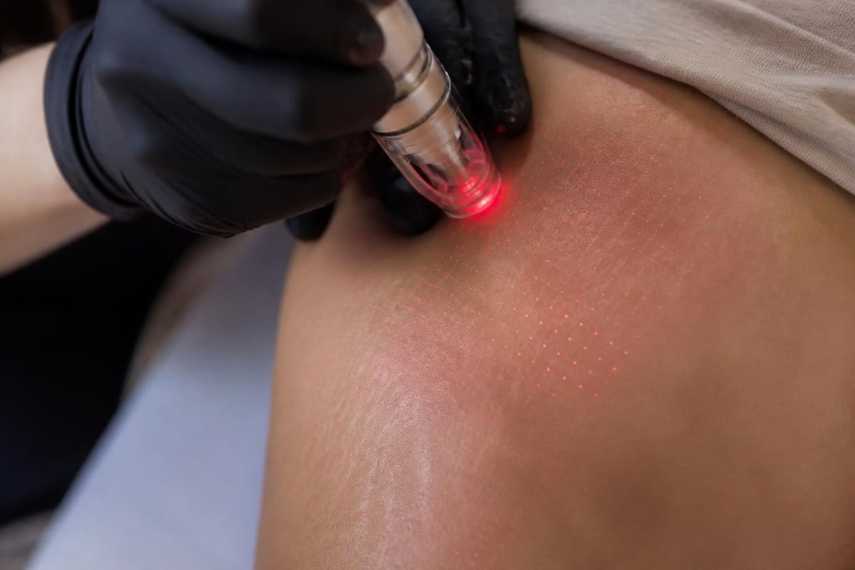 Fractional laser treatment pattern