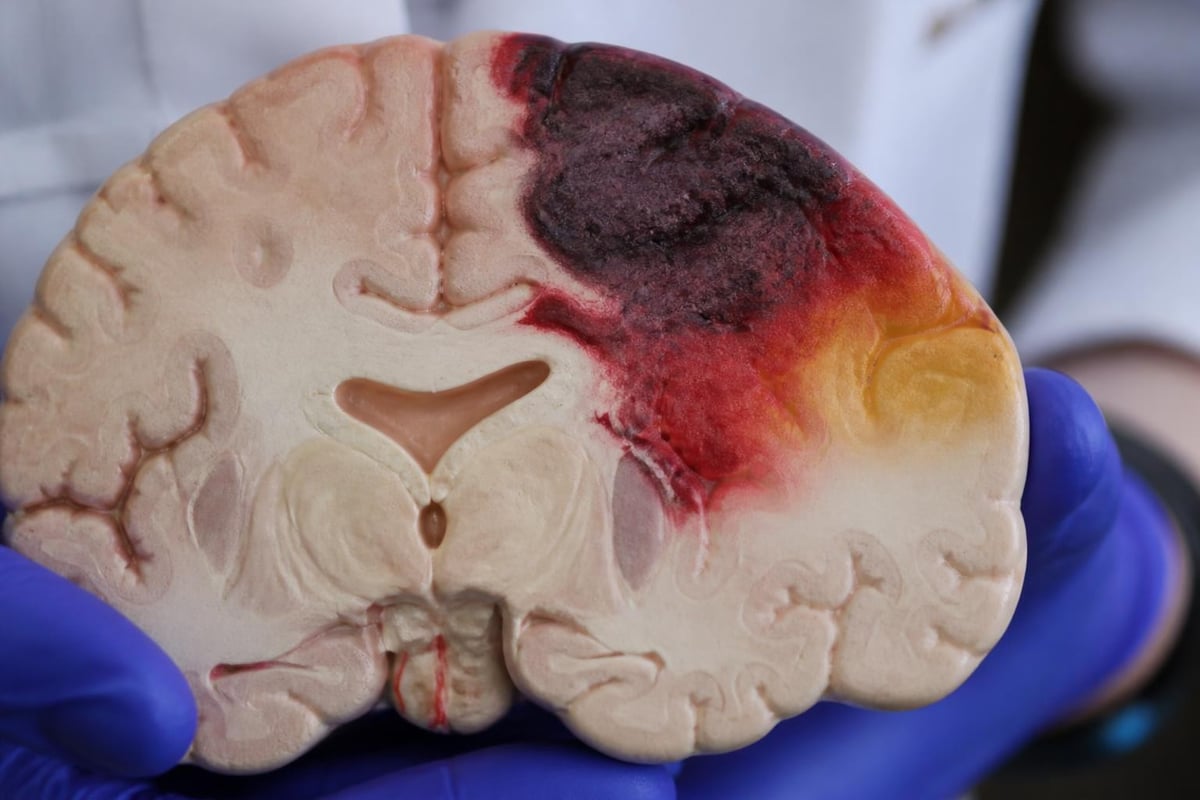 Brain tissue damage patterns after stroke