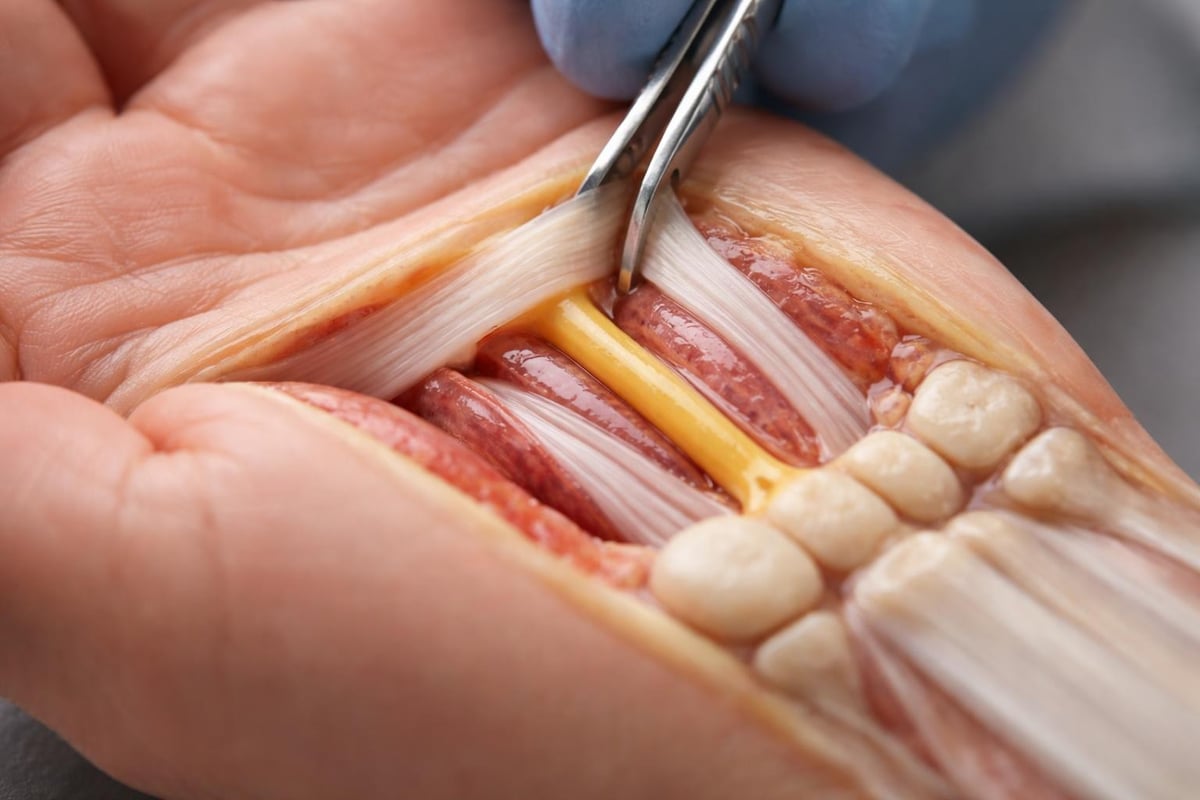 Carpal tunnel anatomy and nerve compression