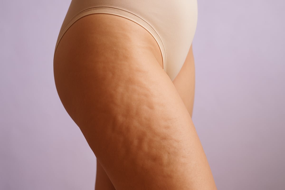 Was ist Cellulite? Ursachen, Mythen & Fakten