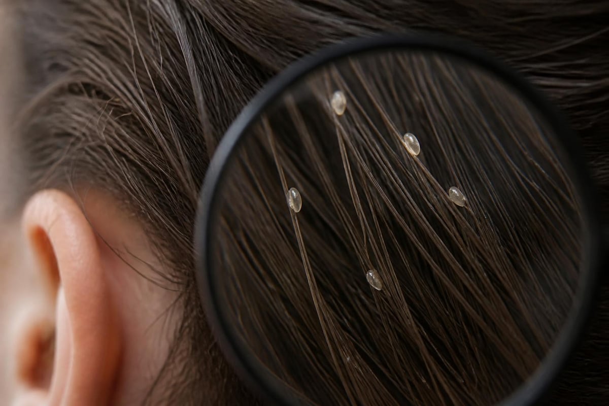 Why home remedies fail against lice nits