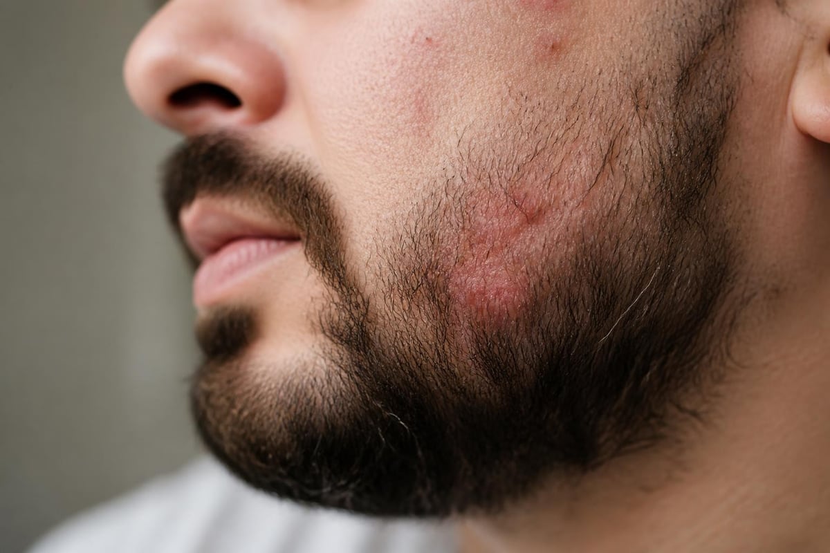 Follicle inflammation cycle