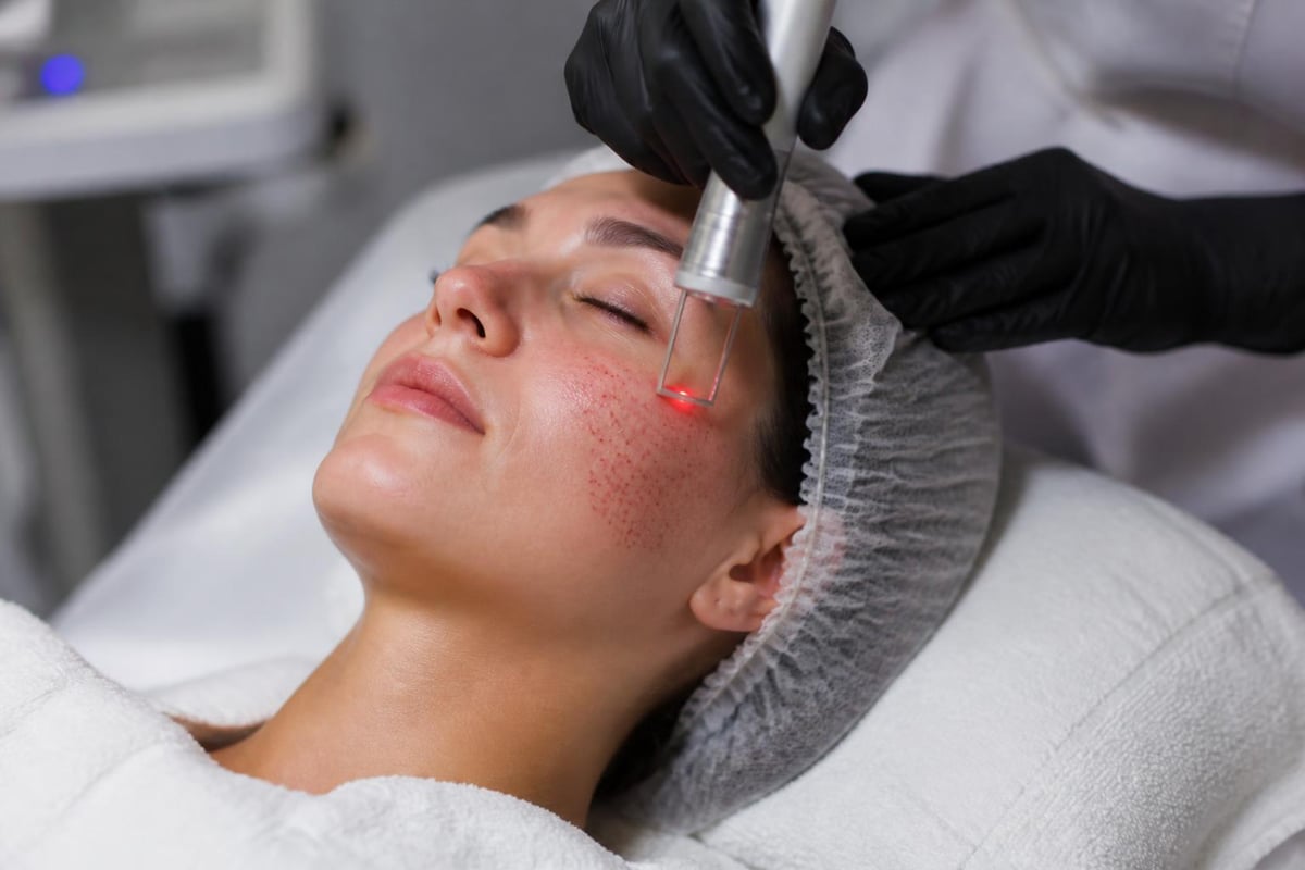 Fractional CO2 laser treatment pattern