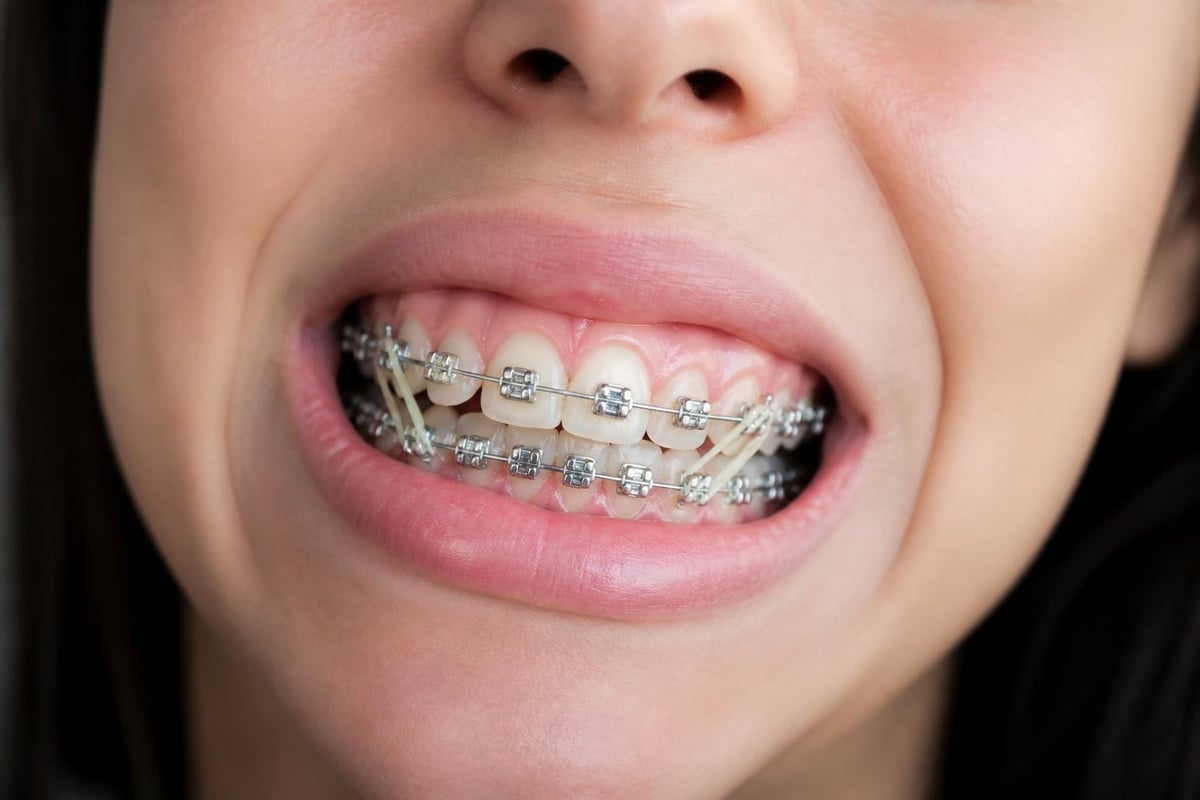 Traditional braces treatment mechanics