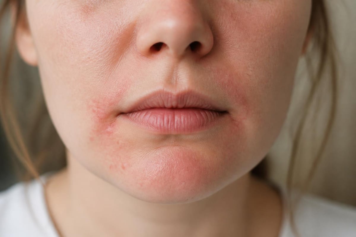 Hormonal triggers for skin inflammation