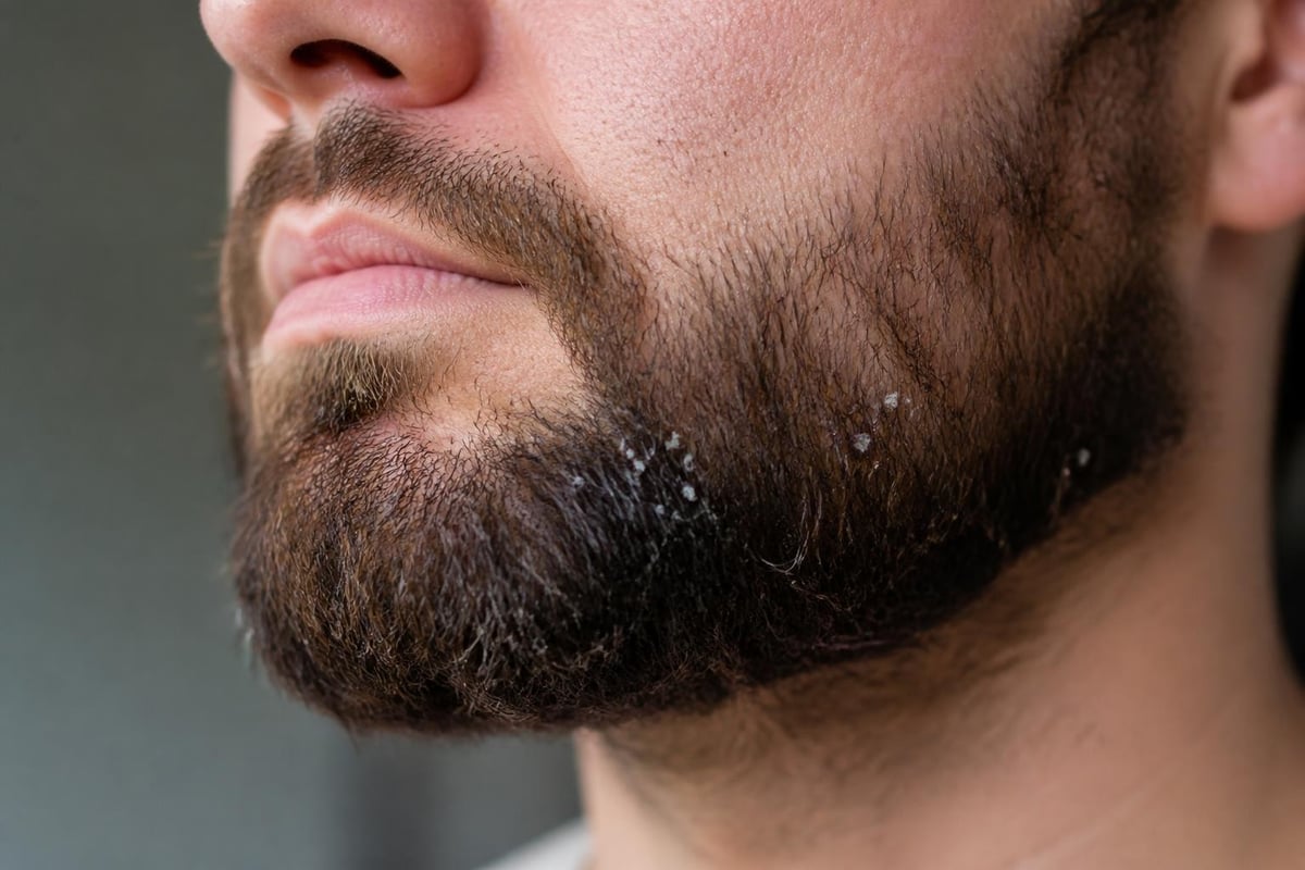 Beard dandruff biological cycle