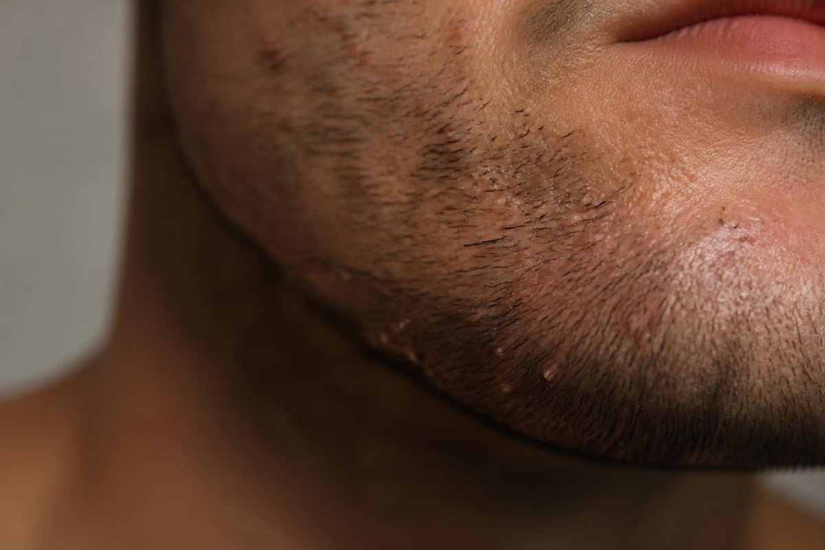 Beard follicle sebum accumulation