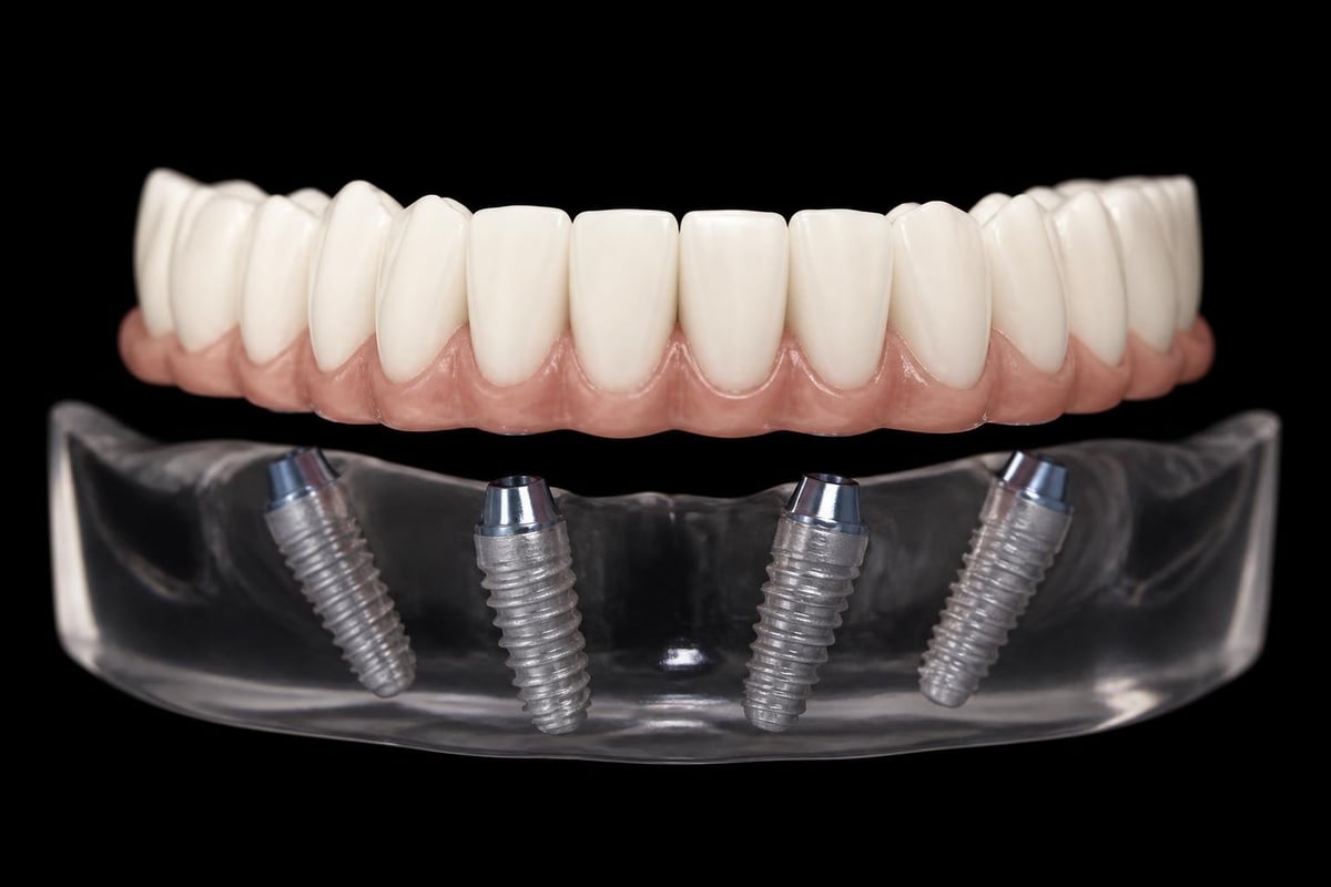 All-on-4 implant placement technique