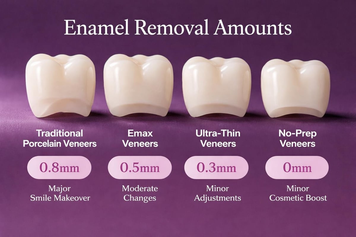Veneer types comparison