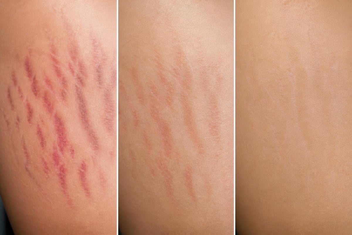 Stretch mark formation timeline