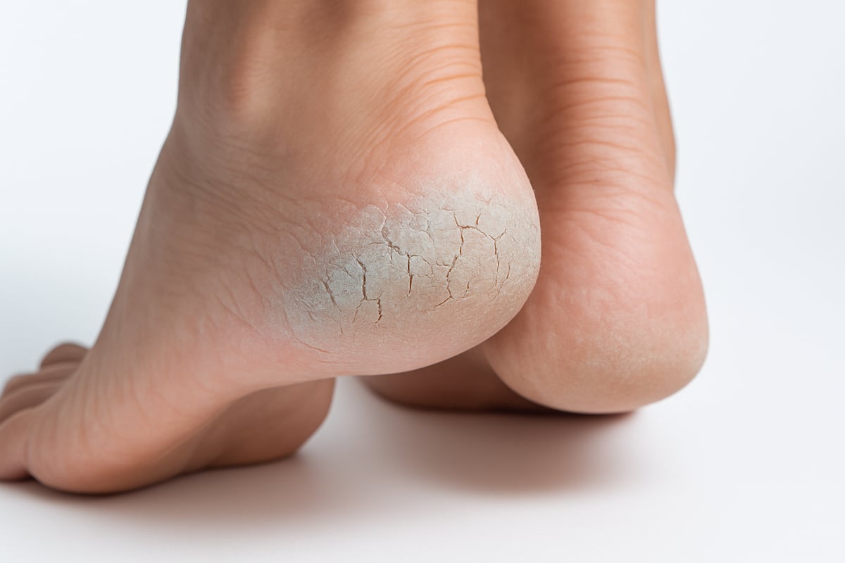 Understanding Dry, Cracked Heels: Causes and Risk Factors