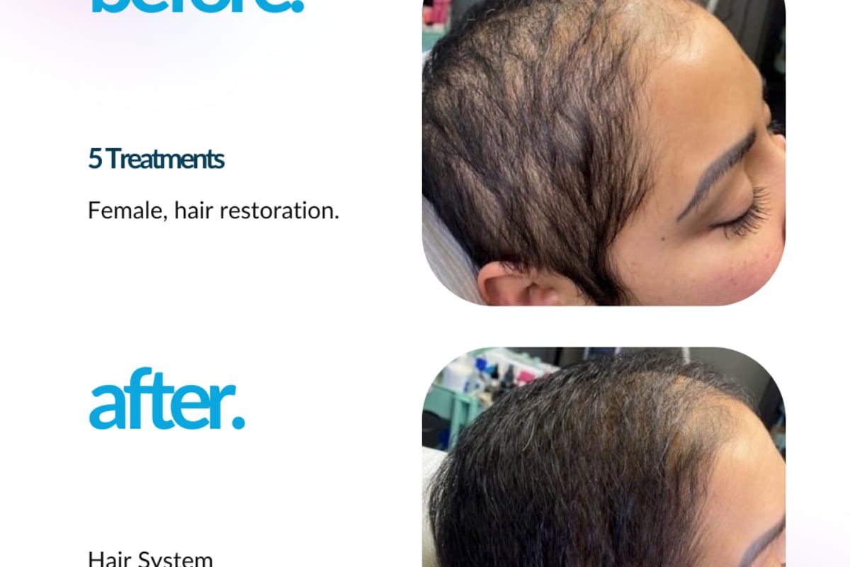 ProCell microchanneling hair restoration service combining collagen stimulation and growth factors The Pixie Garden