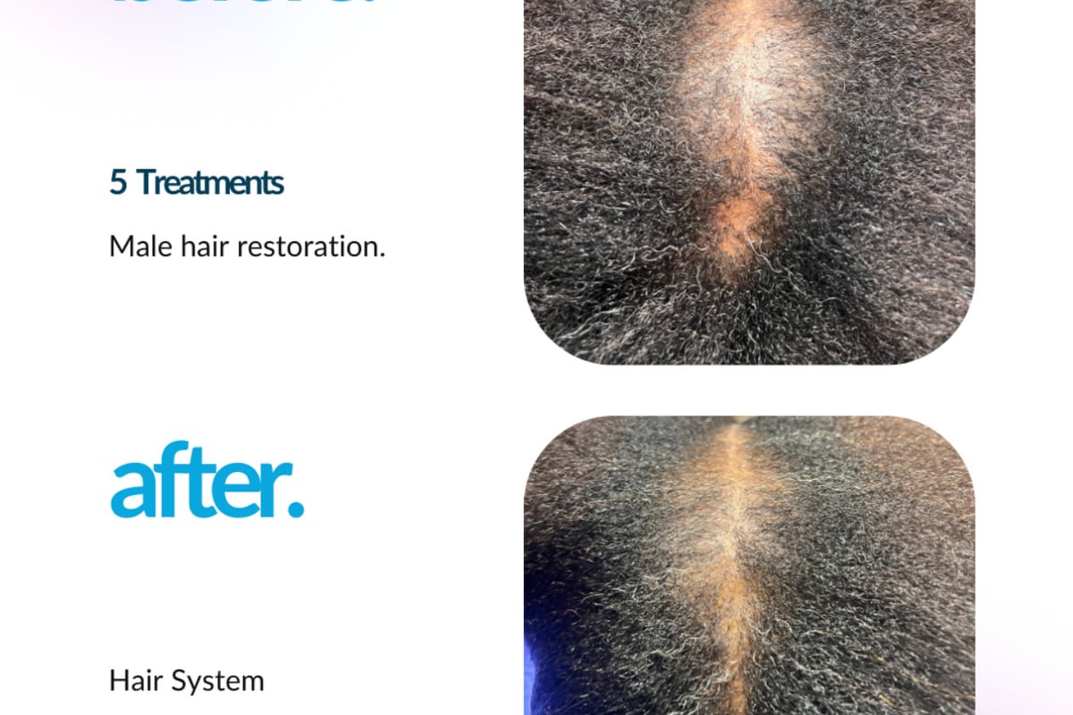ProCell microchanneling scalp treatment delivering growth factors for hair restoration and scalp rejuvenation