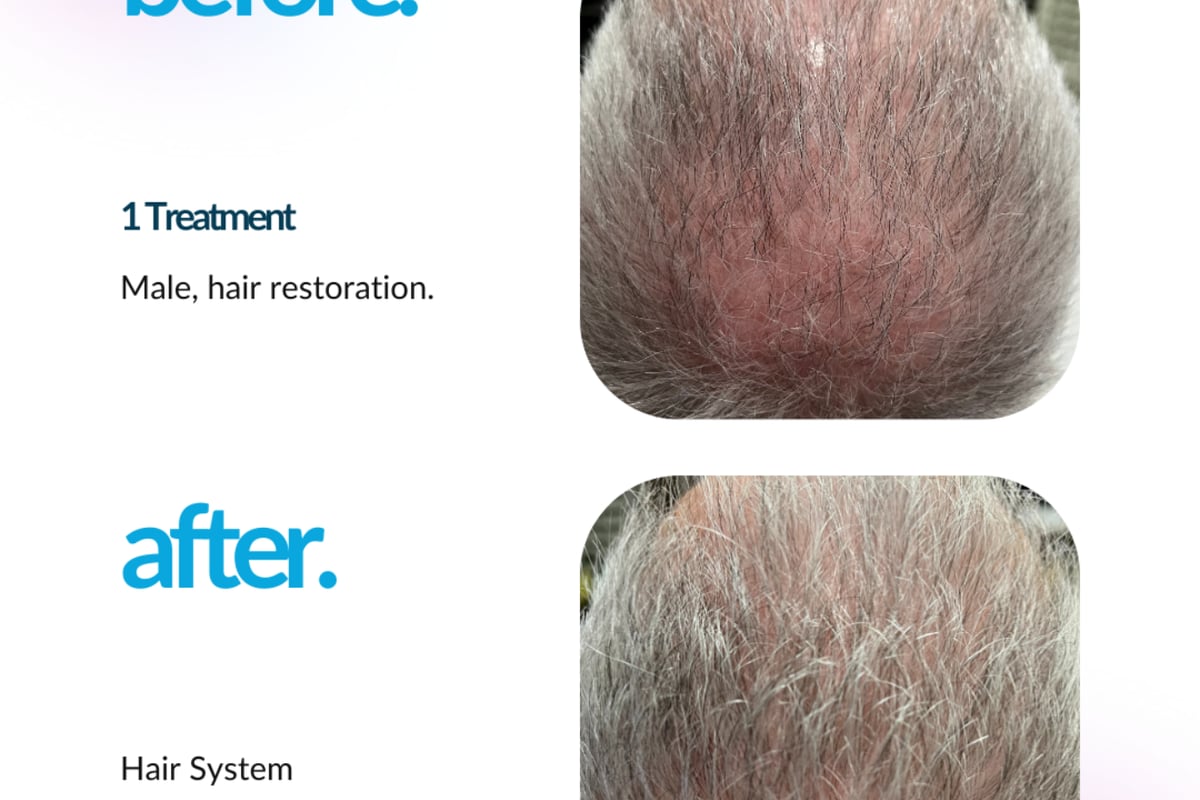 ProCell microchanneling scalp session with professional-use growth factors for non-surgical hair restoration