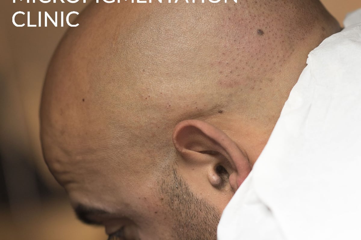 Scalp Micropigmentation - HIS&HERS Micropigmentation Clinic