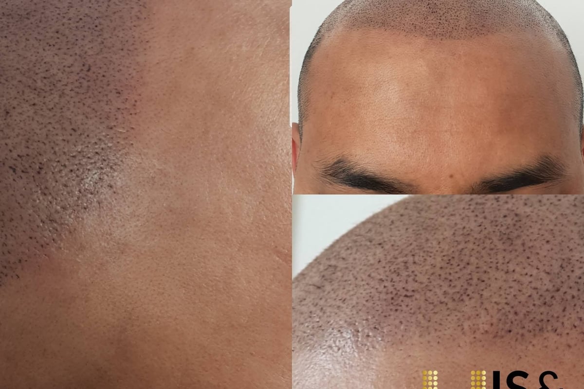Scalp Micropigmentation - HIS&HERS Micropigmentation Clinic