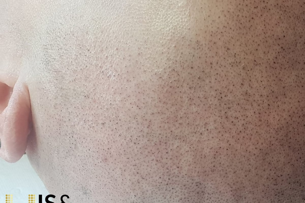 Scalp Micropigmentation - HIS&HERS Micropigmentation Clinic