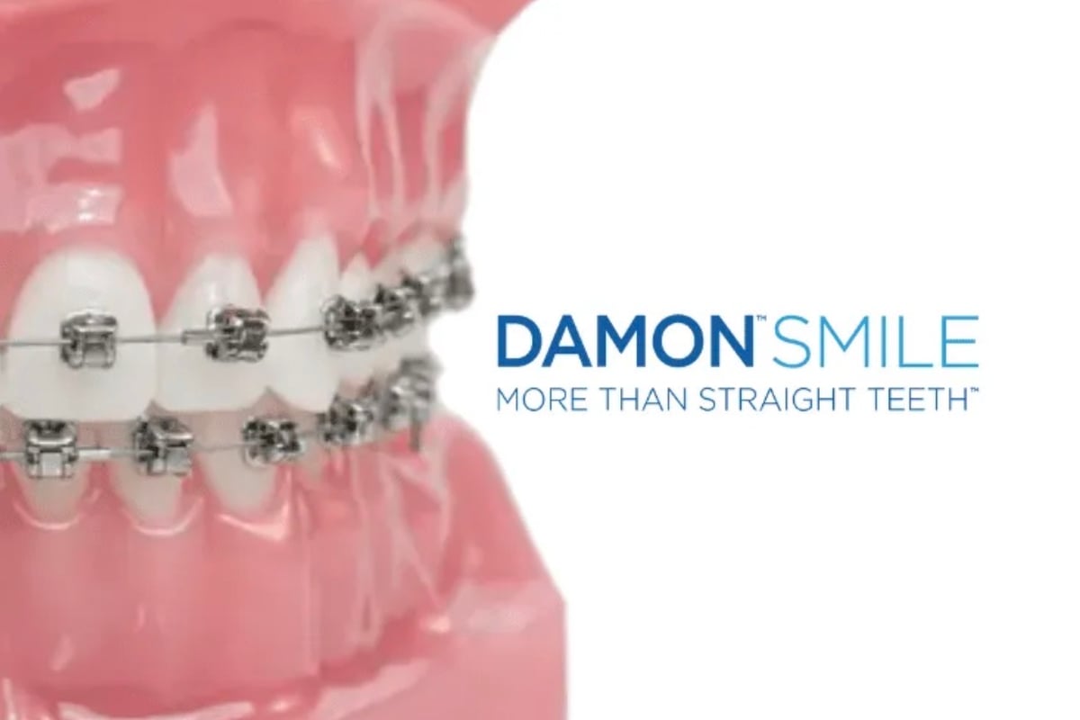 Clear Aligners & Orthodontics - CuraSmile PH