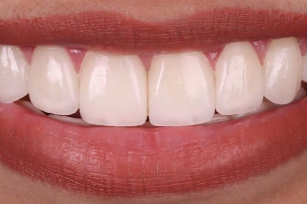 Porcelain Veneers & Dental Crowns - CuraSmile PH