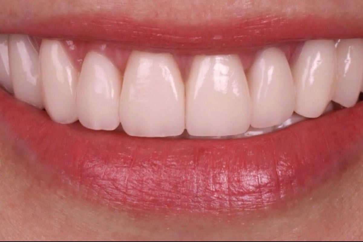 Porcelain Veneers & Dental Crowns - CuraSmile PH