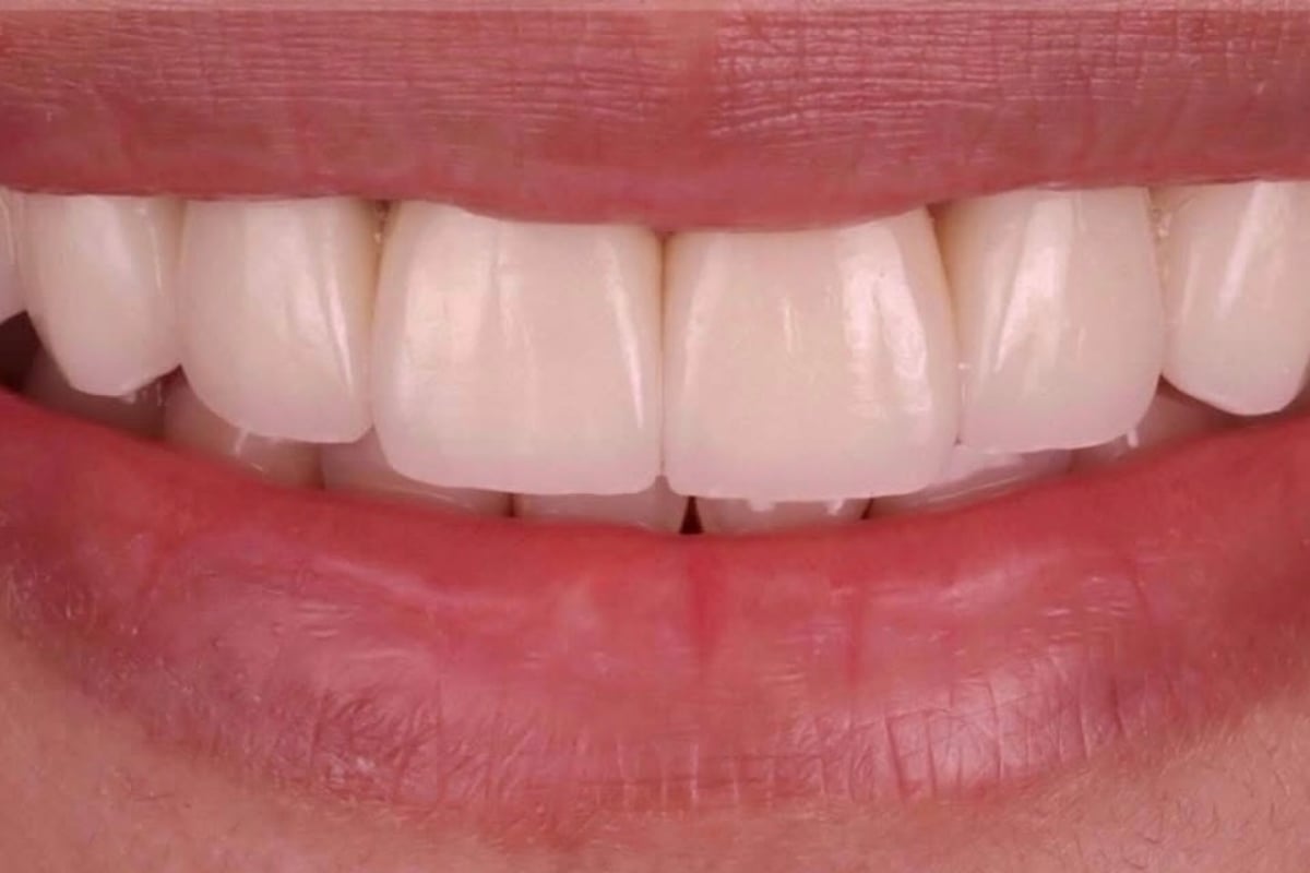 Porcelain Veneers & Dental Crowns - CuraSmile PH