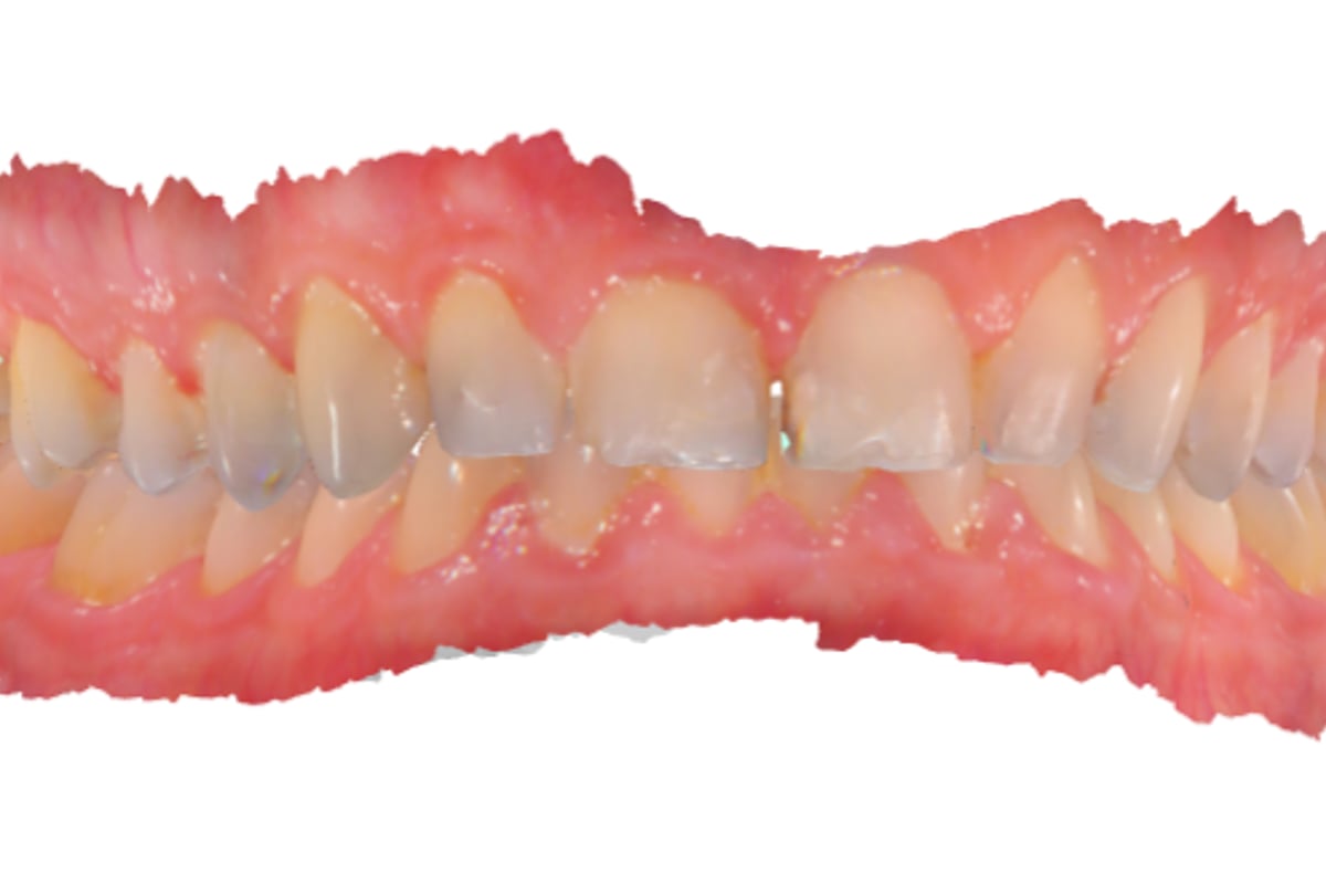 Porcelain Veneers & Dental Crowns - CuraSmile PH